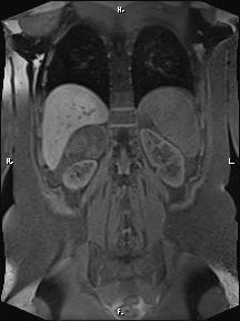 Bilateral adrenal myelolipoma (Radiopaedia 63058-71537 Coronal T1 fat sat 28).jpg