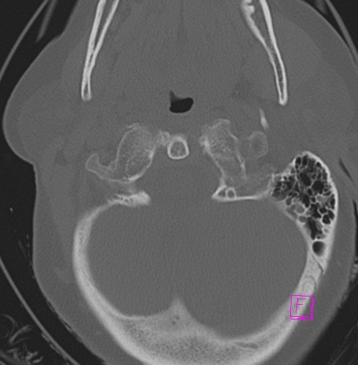 File:Bilateral atlanto-occipital assimilation (Radiopaedia 28350-28603 Axial bone window 8).jpg