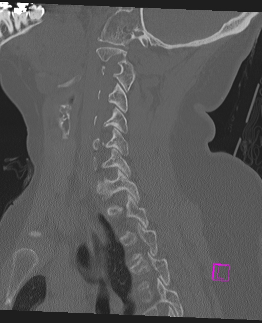 Bilateral atlanto-occipital assimilation (Radiopaedia 28350-28603 Sagittal bone window 51).jpg