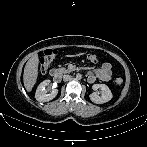 Bilateral benign adrenal adenomas (Radiopaedia 86912-103124 Axial C+ delayed 61).jpg