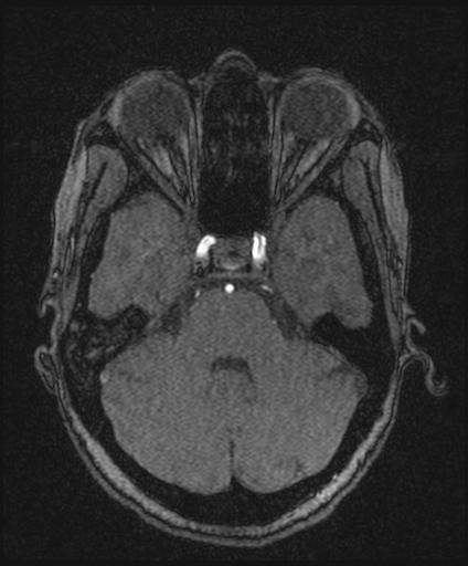 Bilateral carotid body tumors and right glomus jugulare tumor (Radiopaedia 20024-20060 Axial MRA 54).jpg