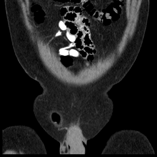 File:Bilateral direct inguinal herniae (Radiopaedia 17016-16719 A 3).jpg