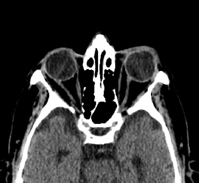 Bilateral ectopia lentis (Radiopaedia 89889-107013 Axial non-contrast 41).jpg