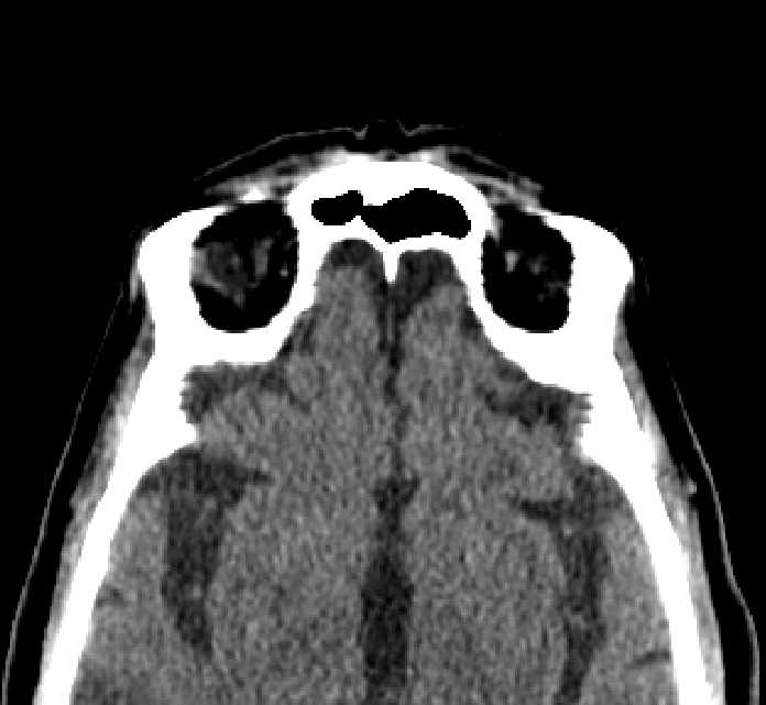 Bilateral ectopia lentis (Radiopaedia 89889-107013 Axial non-contrast 9).jpg