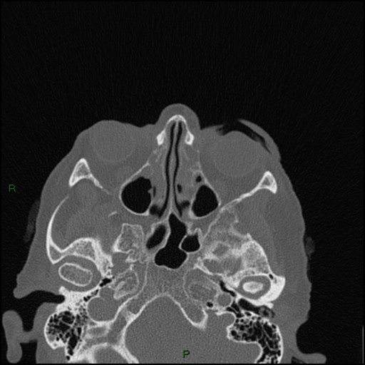 Bilateral frontal mucoceles (Radiopaedia 82352-96454 Axial bone window 163).jpg