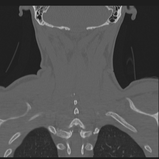 File:Bilateral locked facets (Radiopaedia 33850-35016 Coronal bone window 69).png