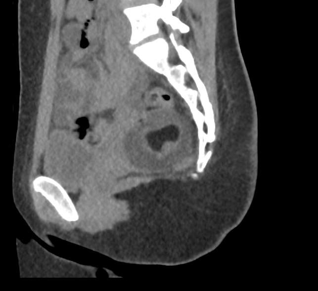 Bilateral mature cystic ovarian teratoma (Radiopaedia 88821-105592 D 39).jpg