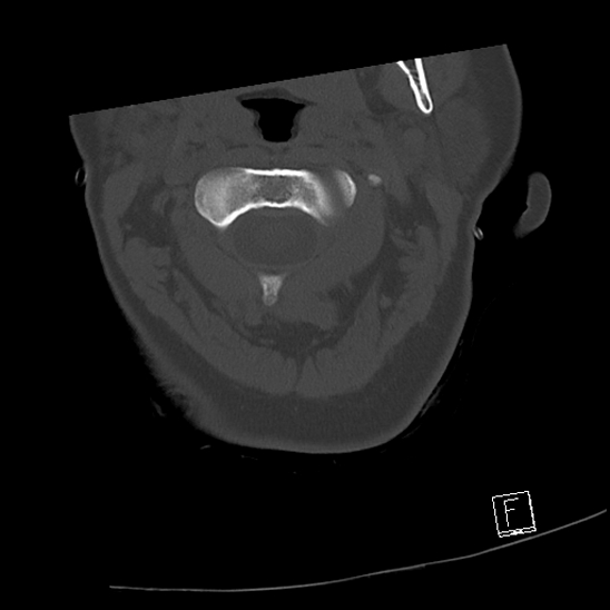 Bilateral occipital condyle fractures (type 3) (Radiopaedia 87672-104086 Axial bone window 21).jpg