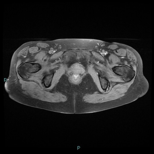 File:Bilateral ovarian fibroma (Radiopaedia 44568-48293 Axial T1 fat sat 25).jpg