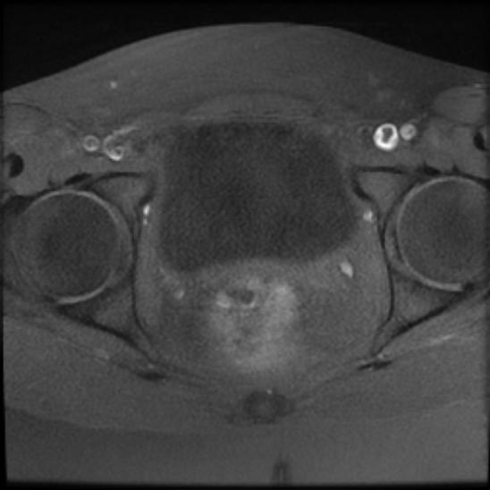 File:Bilateral ovarian fibrothecomas - adolescent (Radiopaedia 86604-102707 Axial T1 fat sat 23).jpg