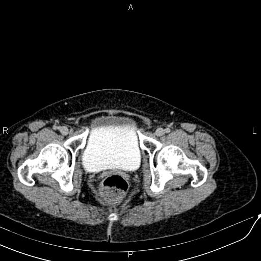 Bilateral ovarian serous cystadenocarcinoma (Radiopaedia 86062-101989 Axial C+ delayed 80).jpg