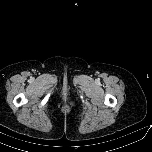 Bilateral ovarian serous cystadenocarcinoma (Radiopaedia 86062-101989 B 112).jpg