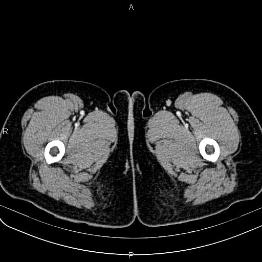 Bilateral ovarian teratoma (Radiopaedia 83131-97503 Axial With contrast 103).jpg