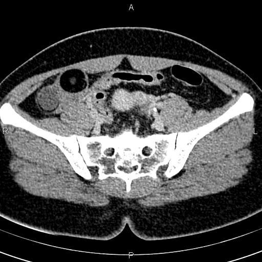 Bilateral ovarian teratoma (Radiopaedia 83131-97503 B 26).jpg