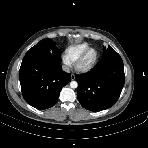 Bilateral pulmonary AVM (Radiopaedia 83134-97505 A 53).jpg