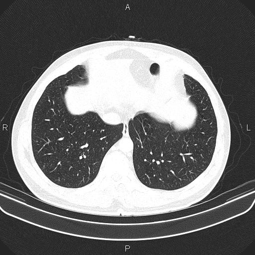 File:Bilateral pulmonary AVM (Radiopaedia 83134-97505 Axial lung window 57).jpg