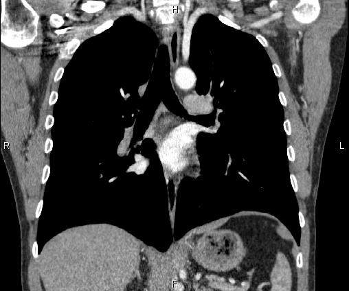 Bilateral pulmonary AVM (Radiopaedia 83134-97505 C 42).jpg