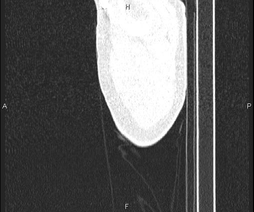 Bilateral pulmonary AVM (Radiopaedia 83134-97505 Sagittal lung window 6).jpg