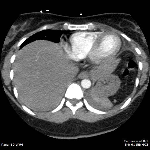 Bilateral pulmonary emboli with Hampton hump sign (Radiopaedia 54070-60246 Axial C+ CTPA 57).jpg