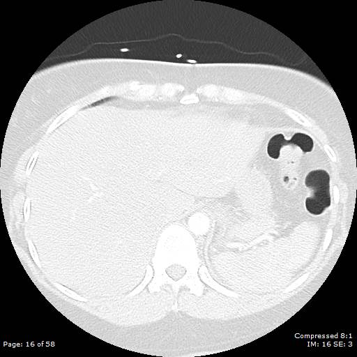 Bilateral pulmonary emboli with Hampton hump sign (Radiopaedia 54070-60246 Axial lung window 16).jpg