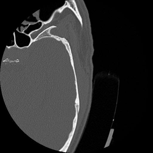 Bilateral temporal bone fractures (Radiopaedia 29482-29970 D 144).jpg
