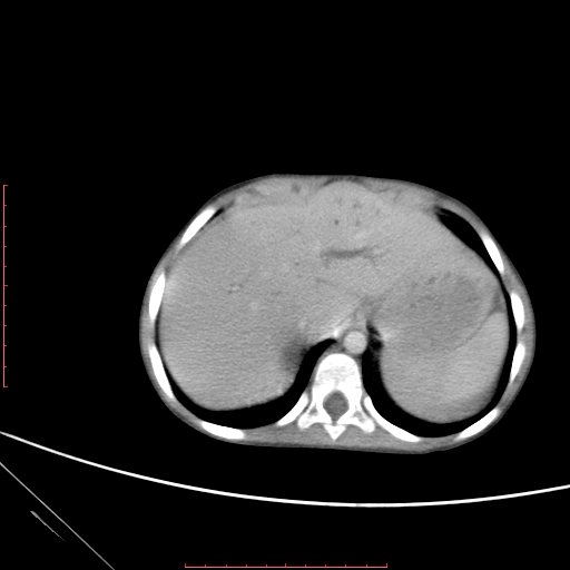 Biliary tract embryonal rhabdomyosarcoma (Radiopaedia 51815-57648 A 5).jpg