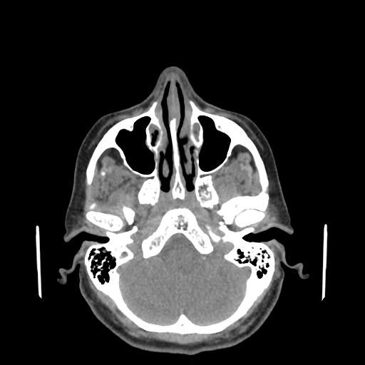 Bisphosphonate-related osteonecrosis of the jaw (Radiopaedia 71324-81642 non-contrast 150).jpg