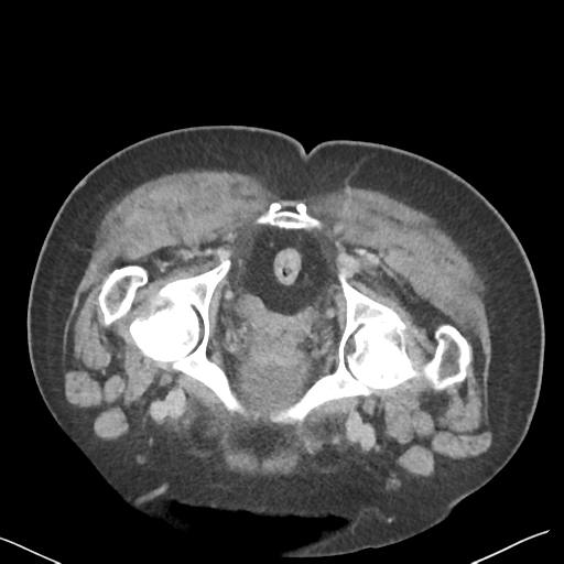 File:Bladder papillary urothelial carcinoma (Radiopaedia 48119-52951 Axial C+ delayed 57).png