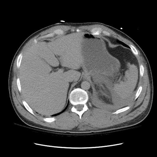 Blunt abdominal trauma with solid organ and musculoskelatal injury with active extravasation (Radiopaedia 68364-77895 Axial C+ delayed 29).jpg