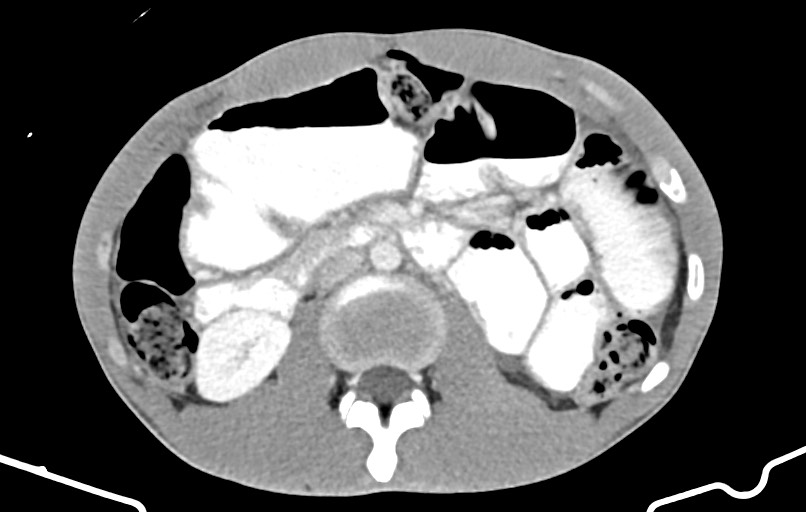 Blunt injury to the small bowel (Radiopaedia 74953-85987 A 72).jpg