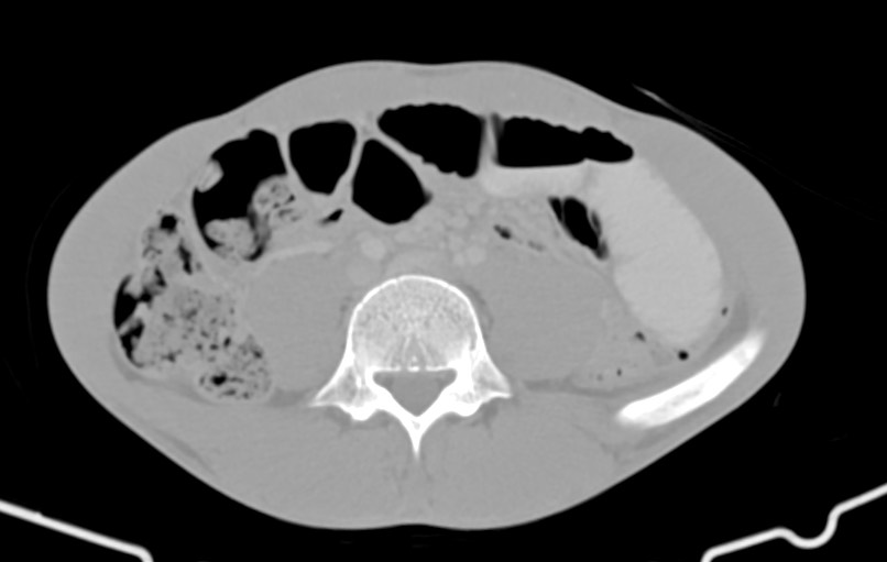 Blunt injury to the small bowel (Radiopaedia 74953-85987 Axial Wide 59).jpg