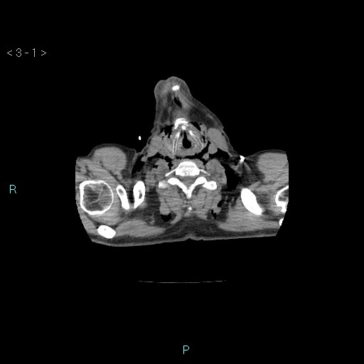 Boerhaave syndrome (Radiopaedia 27683-27897 Axial non-contrast 1).jpg