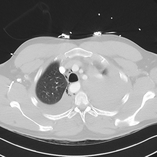 Boerhaave syndrome (Radiopaedia 39382-41661 Axial lung window 12).png