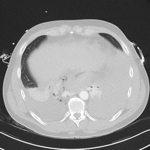Boerhaave syndrome (Radiopaedia 39382-41661 Axial lung window 44).png