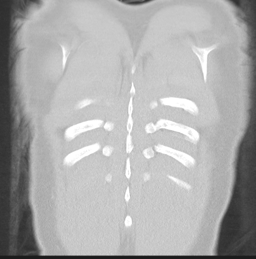 Boerhaave syndrome (Radiopaedia 39382-41661 Coronal lung window 48).png