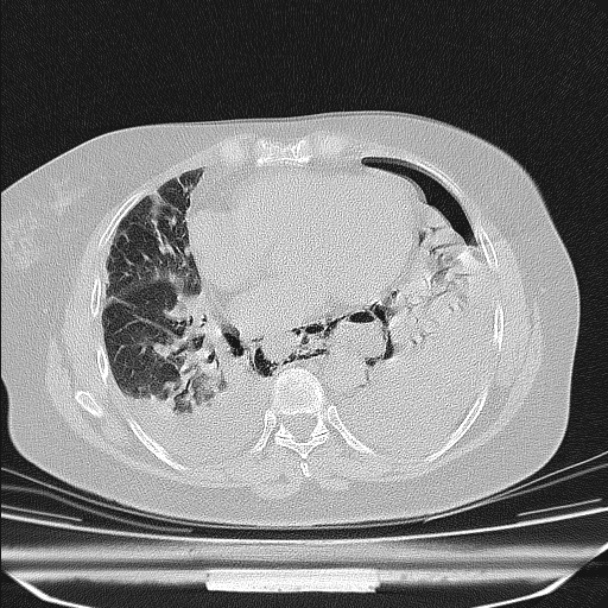 Boerhaave syndrome (Radiopaedia 45644-49799 Axial lung window 77).jpg