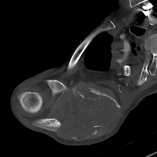 Bone metastasis from squamous cell carcinoma (Radiopaedia 30133-30730 A 53).jpg