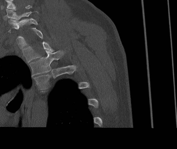 Bony Bankart and Hill-Sachs lesions (Radiopaedia 33622-34727 Sagittal bone window 78).png