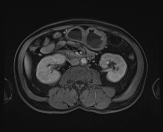 Bouveret syndrome (Radiopaedia 61017-68856 Axial T1 C+ fat sat 49).jpg