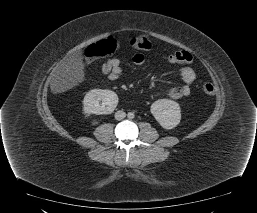 Bowel and splenic infarcts in acute lymphocytic leukemia (Radiopaedia 61055-68913 A 73).jpg