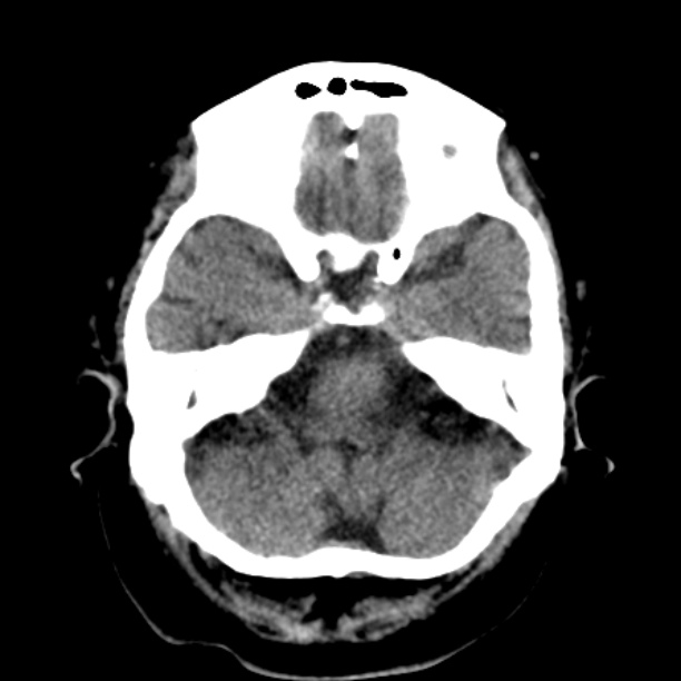Brain cortical laminar necrosis (Radiopaedia 25822-25971 Axial non-contrast 10).jpg