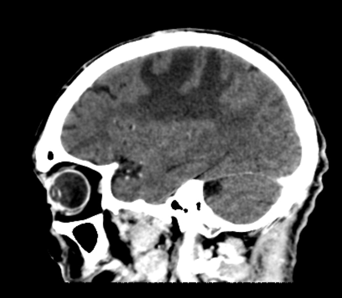 Brain metastases from lung cancer (Radiopaedia 27849-28092 Sagittal C+ delayed 18).jpg