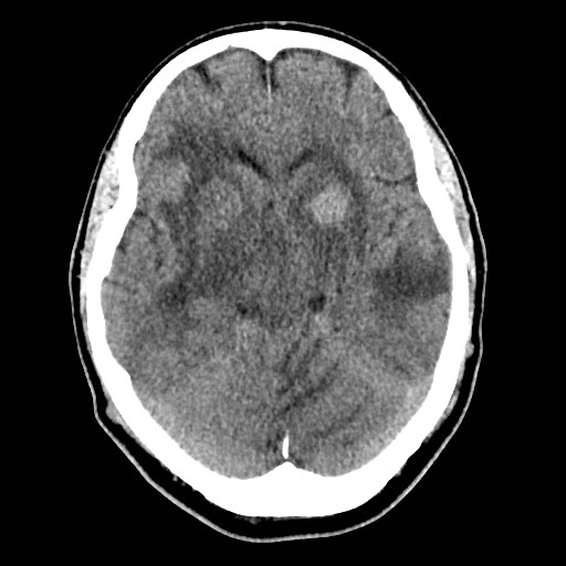 File:Brain metastases from lung cancer (Radiopaedia 83839-99027 Axial non-contrast 14).jpg