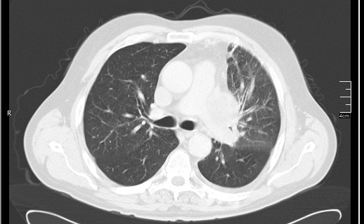 Brain metastases from squamocellular lung cancer (Radiopaedia 56515-63219 Axial lung window 29).jpg
