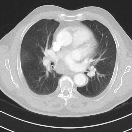 Brain metastasis (large cystic mass) (Radiopaedia 47497-52104 Axial lung window 23).png