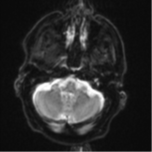 File:Brain metastasis (lung cancer) (Radiopaedia 48289-53179 Axial DWI 5).png