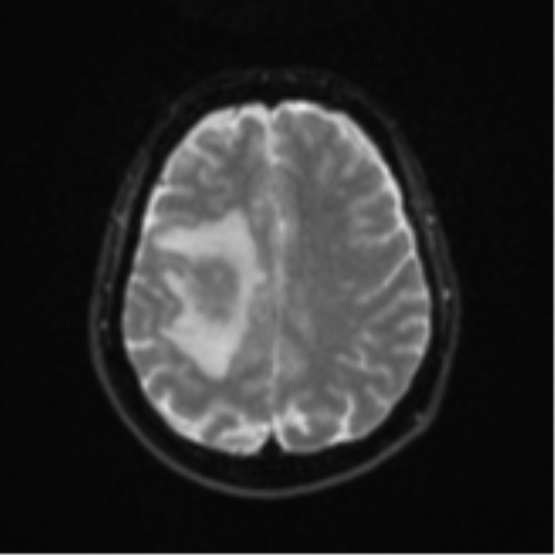 Brain metastasis (sarcoma) (Radiopaedia 47576-52209 Axial DWI 19).png