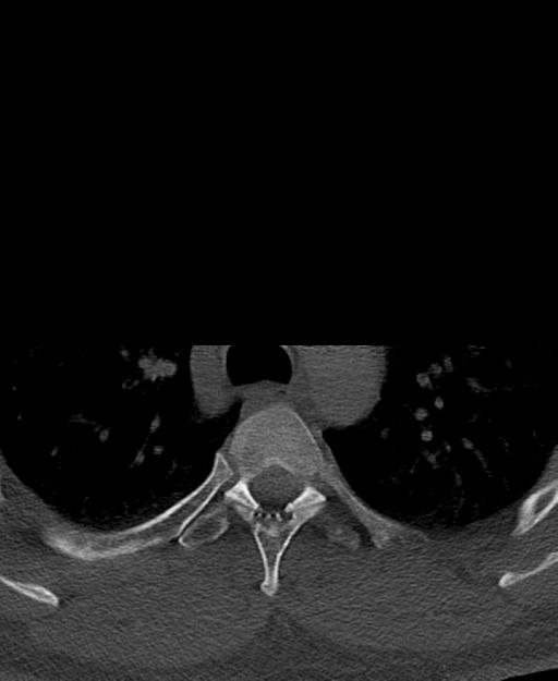 Branchial cleft cyst (Radiopaedia 31167-31875 Axial bone window 87).jpg