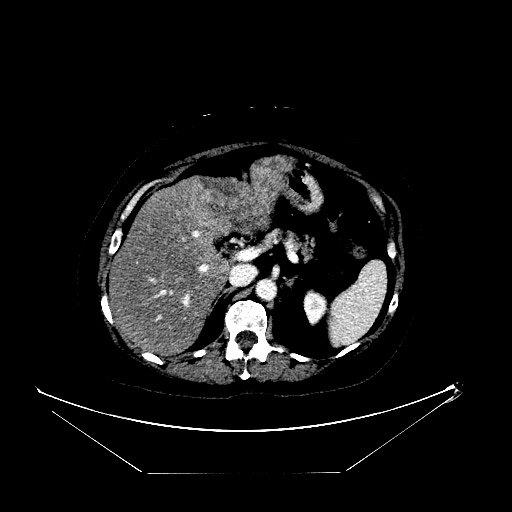 File:Breast cancer pseudocirrhosis with lobar invovlement (Radiopaedia 81080-94670 Axial liver window 54).jpg