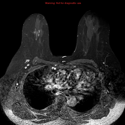 File:Breast carcinoma (multicentric multifocal in mammary Paget disease) (Radiopaedia 50966-56512 Axial T1 C+ fat sat 12).jpg